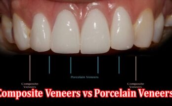 Complete Guide to Composite Veneers vs Porcelain Veneers