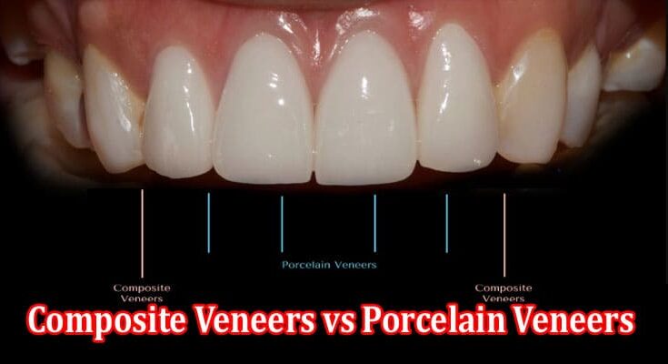 Complete Guide to Composite Veneers vs Porcelain Veneers