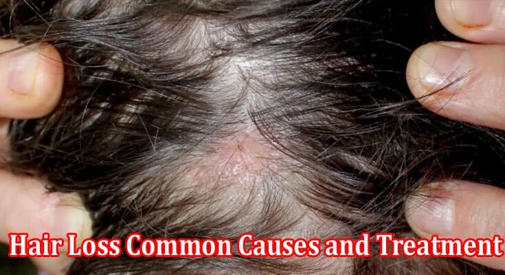 About General Information Hair Loss Common Causes and Treatment